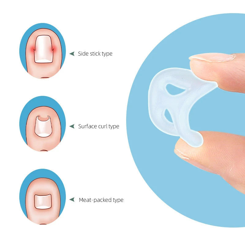 5Pcs Silicone Ingrown Correction Invisible Ingrown Toe Nail Elastic Straighter Clip Brace Pedicure Foot Care Protector